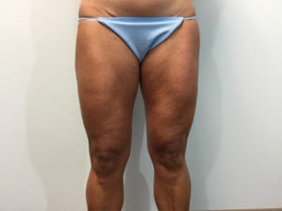 Liposuction Before & After Gallery - Patient 4726794 - Image 2
