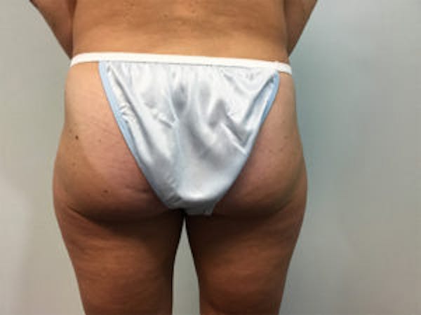 Liposuction Before & After Gallery - Patient 4726794 - Image 3