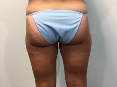 Liposuction Before & After Gallery - Patient 4726794 - Image 4