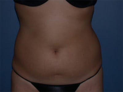 Liposuction Before & After Gallery - Patient 4726795 - Image 1