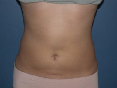 Liposuction Before & After Gallery - Patient 4726795 - Image 2