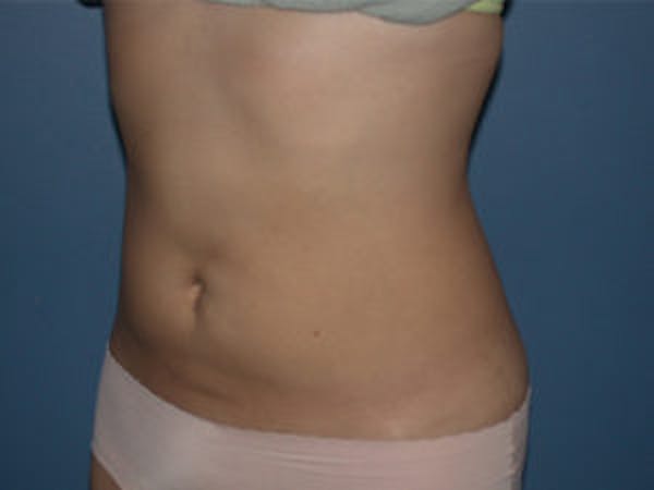Liposuction Gallery - Patient 4726795 - Image 4