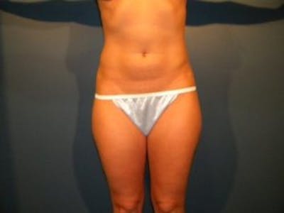 Liposuction Before & After Gallery - Patient 4726797 - Image 1
