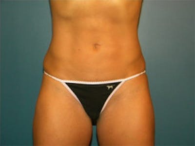 Liposuction Before & After Gallery - Patient 4726797 - Image 2