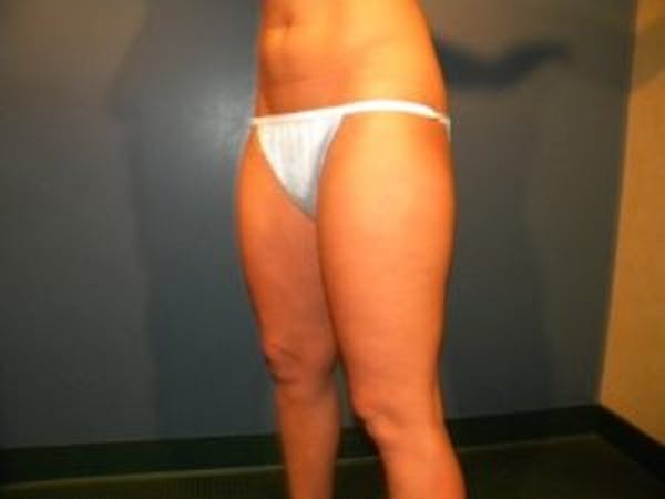 Liposuction Before & After Gallery - Patient 4726797 - Image 3
