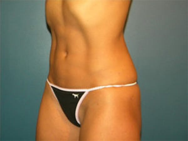 Liposuction Before & After Gallery - Patient 4726797 - Image 4