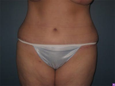 Liposuction Before & After Gallery - Patient 4726798 - Image 2