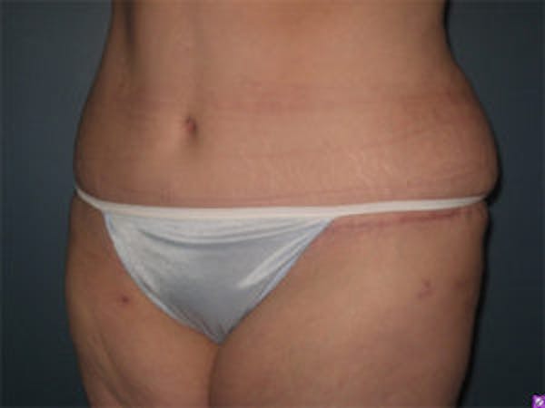 Liposuction Before & After Gallery - Patient 4726798 - Image 4