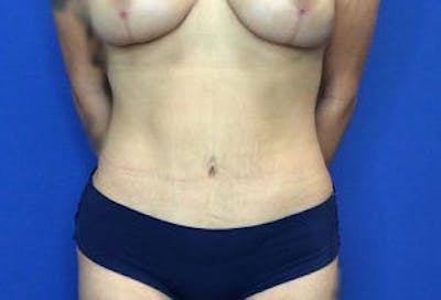 Liposuction Before & After Gallery - Patient 4726799 - Image 2