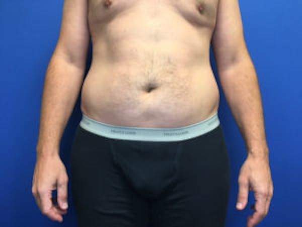 Liposuction Before & After Gallery - Patient 4726800 - Image 1