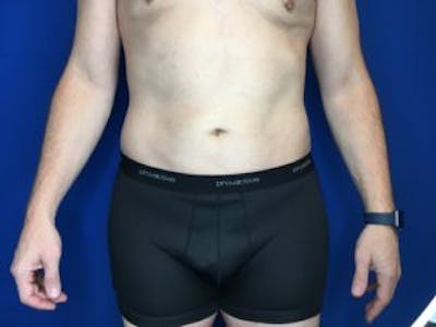 Liposuction Before & After Gallery - Patient 4726800 - Image 2