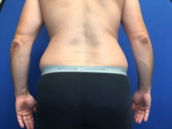 Liposuction Before & After Gallery - Patient 4726800 - Image 3