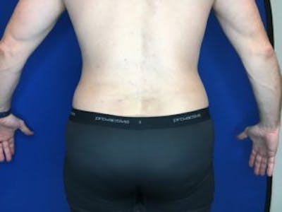 Liposuction Before & After Gallery - Patient 4726800 - Image 4