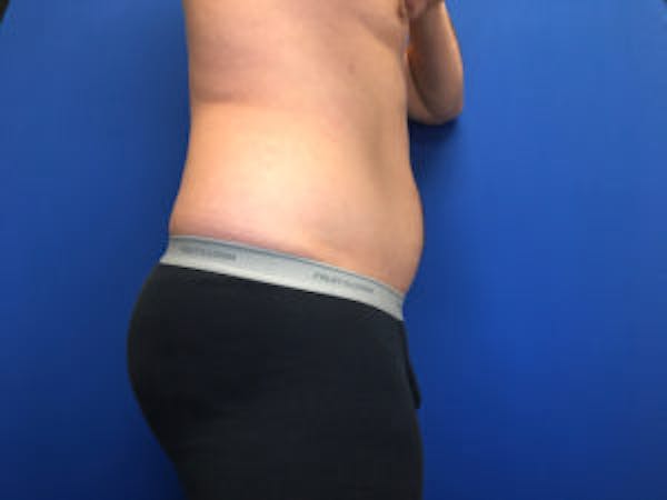 Liposuction Before & After Gallery - Patient 4726800 - Image 5
