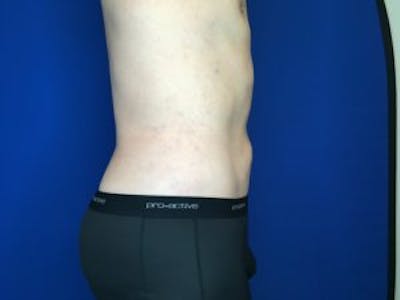 Liposuction Before & After Gallery - Patient 4726800 - Image 6
