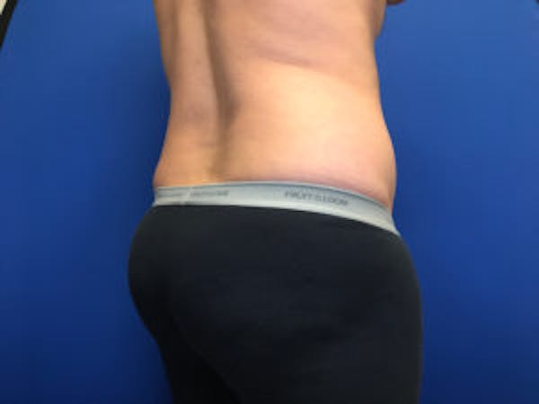 Liposuction Before & After Gallery - Patient 4726800 - Image 7