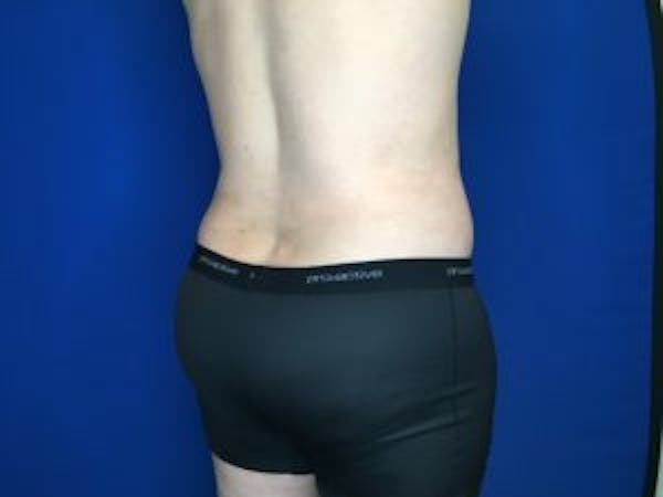 Liposuction Before & After Gallery - Patient 4726800 - Image 8