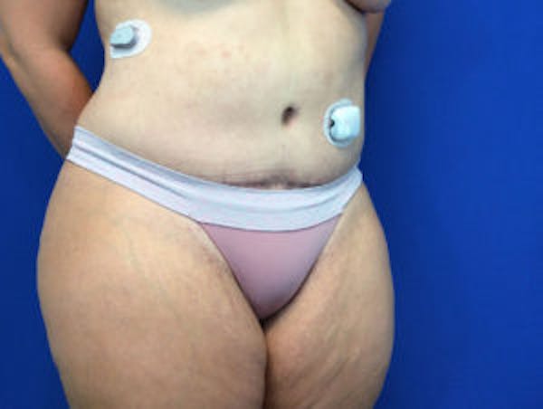 Liposuction Before & After Gallery - Patient 4726801 - Image 4