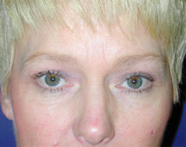 Blepharoplasty Before & After Gallery - Patient 4595019 - Image 1