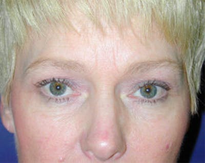 Blepharoplasty Before & After Gallery - Patient 4595019 - Image 1