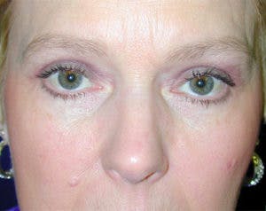 Eyelid Surgery