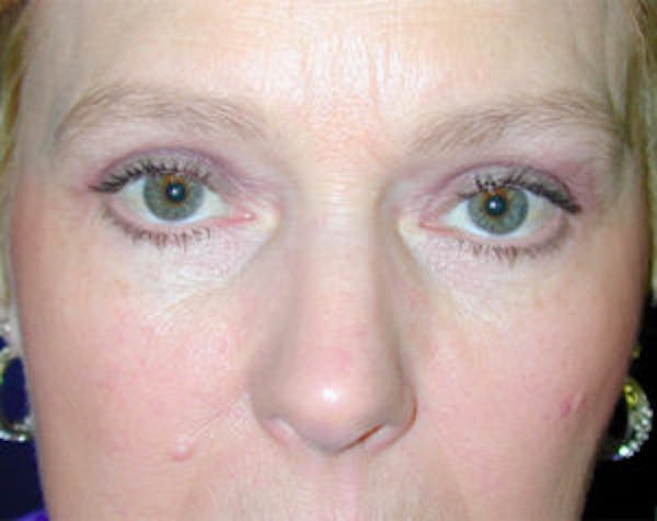 Blepharoplasty Before & After Gallery - Patient 4595019 - Image 2