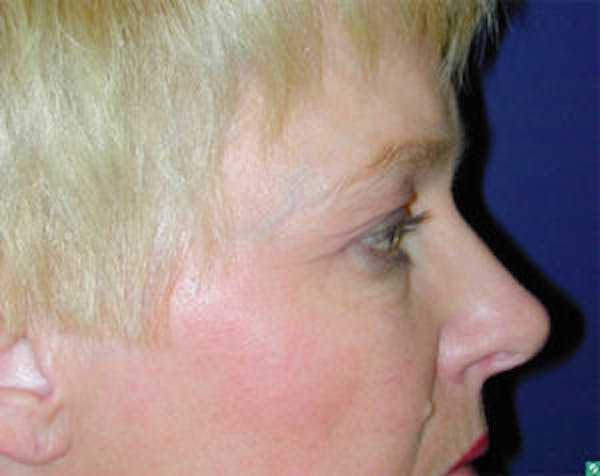 Blepharoplasty Before & After Gallery - Patient 4595019 - Image 3
