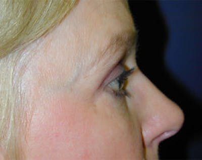 Blepharoplasty Before & After Gallery - Patient 4595019 - Image 4