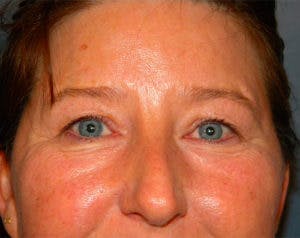 Eyelid Surgery