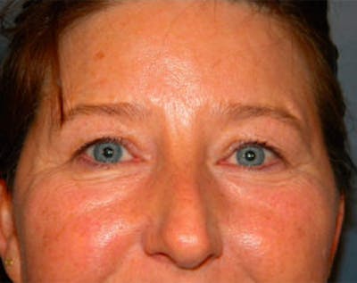 Blepharoplasty Before & After Gallery - Patient 4595024 - Image 1