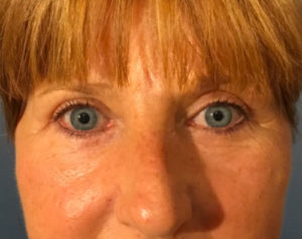 Blepharoplasty Before & After Gallery - Patient 4595024 - Image 2