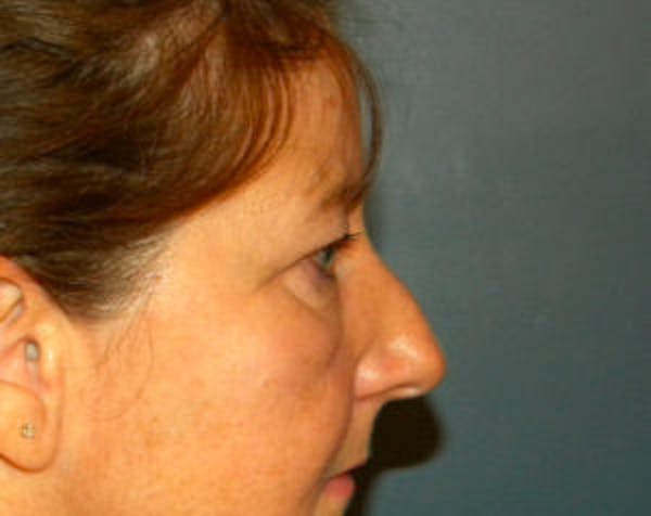 Blepharoplasty Before & After Gallery - Patient 4595024 - Image 3
