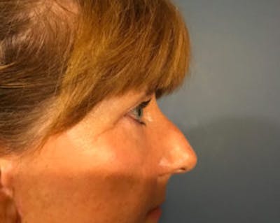 Blepharoplasty Before & After Gallery - Patient 4595024 - Image 4