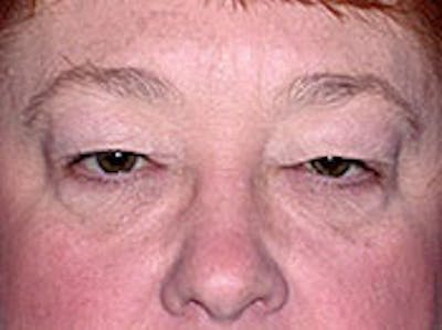 Blepharoplasty Before & After Gallery - Patient 4595045 - Image 1