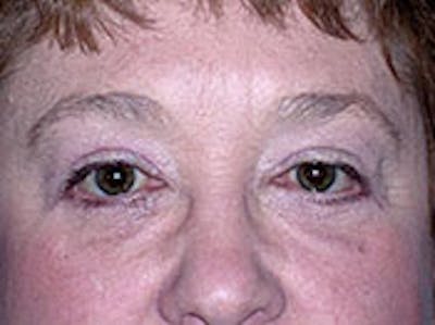 Blepharoplasty Before & After Gallery - Patient 4595045 - Image 2