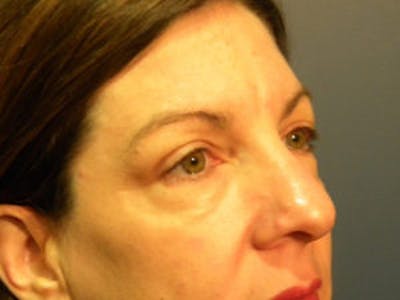 Blepharoplasty Before & After Gallery - Patient 4595054 - Image 1