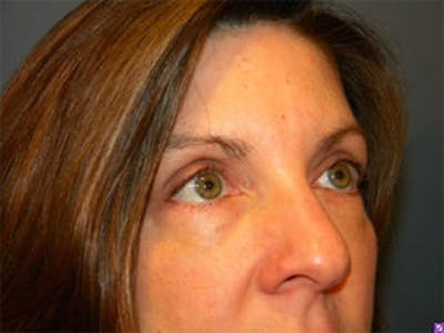 Blepharoplasty Before & After Gallery - Patient 4595054 - Image 2