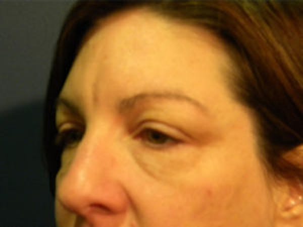 Blepharoplasty Before & After Gallery - Patient 4595054 - Image 3