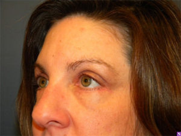 Blepharoplasty Before & After Gallery - Patient 4595054 - Image 4