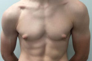 Gynecomastia