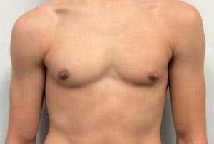 Gynecomastia