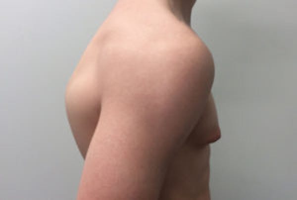 Gynecomastia Before & After Gallery - Patient 4595111 - Image 3