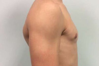 Gynecomastia Before & After Gallery - Patient 4595111 - Image 4
