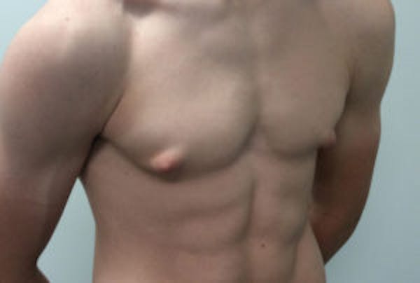 Gynecomastia Before & After Gallery - Patient 4595111 - Image 5