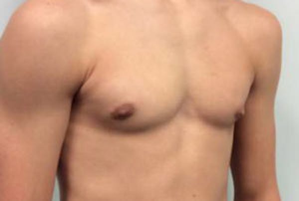 Gynecomastia Before & After Gallery - Patient 4595111 - Image 6