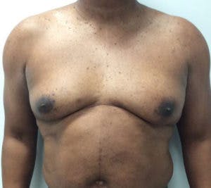 Gynecomastia