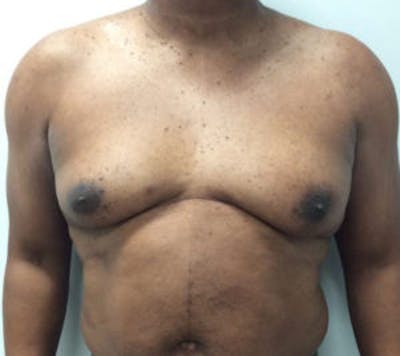 Gynecomastia Before & After Gallery - Patient 4595112 - Image 1