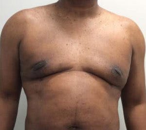 Gynecomastia