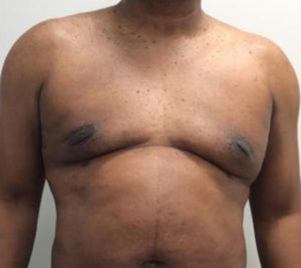 Gynecomastia Before & After Gallery - Patient 4595112 - Image 2