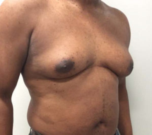 Gynecomastia Before & After Gallery - Patient 4595112 - Image 3